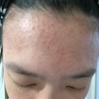 祖传秘方 专业治疗脸上长疥疮、痤疮、青春痘  1瓶198元
